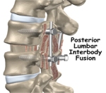 posterior-lumbar-interbody-fusion-surgery1