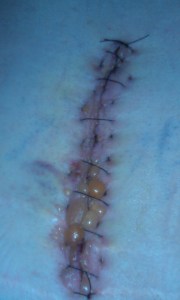 Spinal Scar